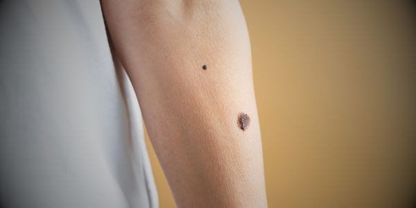 Moles in Astrology